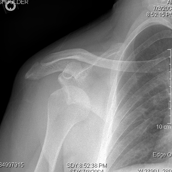 A 23-year-old man comes to the emergency department after injuring his right shoulder during a basketball game.  He was trying to block a shot when his abducted and externally rotated arm was forced backward by an opposing player.  The patient immediately felt excruciating pain and fell to the ground holding his right arm.  He has no other medical conditions and has never had a similar injury.  On examination, there is gross asymmetry of the right shoulder compared to the left, and the right arm is held in slight abduction and external rotation.  Distal pulses are full.  Plain film x-ray of the right shoulder is shown below.   If left untreated, which of the following is the most likely complication of this patient's injury? A) Inability to extend fingers B) Loss of the biceps reflex C) Numbness of the medial 2 fingers D) Shoulder abduction weakness E) Winging of the scapula