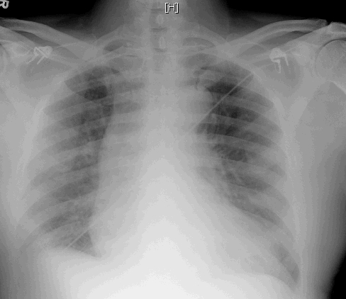 A 43-year-old construction worker is brought to the emergency department after falling 6.1 m (20 ft)  from faulty scaffolding.  The patient has severe chest pain and appears scared.  Blood pressure is 136/92 mm Hg, and pulse is 120/min.  Chest x-ray is shown below.   Which of the following is the most likely diagnosis in this patient? A) Blunt aortic injury B) Diaphragmatic rupture C) Left ventricular aneurysm D) Myocardial contusion E) Pulmonary contusion F) Tracheobronchial disruption