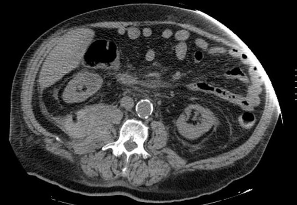 A 70-year-old male presents to the emergency room complaining of weakness, dizziness and back pain.  He denies nausea, vomiting, diarrhea, chest pain, palpitations, shortness of breath, urinary symptoms, or black stools.  His past medical history is significant for diabetes mellitus, diabetic nephropathy and retinopathy, hypertension, atrial fibrillation and chronic leg cellulitis.  He takes warfarin for chronic anticoagulation.  On physical examination, his blood pressure is 120/70 mmHg and his heart rate is 110 and irregular.  His WBC count is 10,500/mm<sup>3</sup>, hemoglobin level is 7.0 g/dL and platelet count is 170,000/mm3.  An abdominal CT image is shown on the slide below.   Which of the following is the most likely diagnosis? A) Renal cell carcinoma B) Vertebral fracture C) Retroperitoneal hematoma D) Hydronephrosis E) Mesenteric ischemia