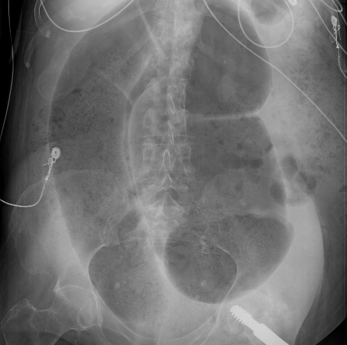 A 75-year-old man is brought to the emergency department due to worsening generalized abdominal pain and nausea for the past 2 days.  He has multiple chronic medical conditions and resides at a nursing facility.  Temperature is 37.2 C (99 F) , blood pressure is 128/74 mm Hg, and pulse is 94/min.  Abdominal examination shows distension and diffuse tenderness without rigidity or rebound tenderness.  Abdominal x-ray is shown in the image below:   Which of the following factors in this patient's history most likely increased the risk for developing this condition? A) Chronic constipation B) Colonic hypermotility C) Electrolyte abnormalities D) Nonsteroidal anti-inflammatory drug use E) Recent antibiotic therapy