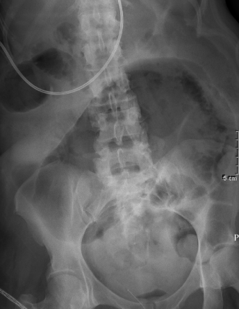 A 37-year-old man comes to the emergency department due to 2 days of progressive, colicky abdominal pain, abdominal distension, nausea, and vomiting.  He had a similar episode 2 years ago that resolved spontaneously and did not require medical attention.  He has no chronic medical conditions.  Temperature is 36.8 C (98.2 F) , blood pressure is 122/80 mm Hg, and pulse is 92/min.  The abdomen is distended and tender without rigidity or guarding.  Abdominal x-ray is shown in the image below:   Which of the following is the most likely diagnosis? A) Cecal volvulus B) Gastric outlet obstruction C) Ileocolic intussusception D) Paralytic ileus E) Toxic megacolon