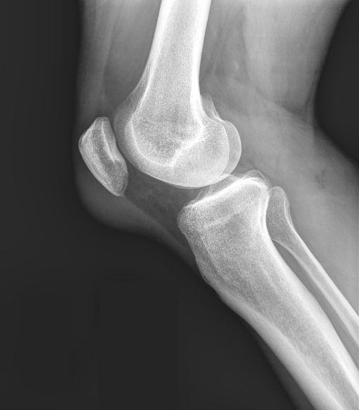 A 63-year-old man comes to the emergency department due to a 2-day history of right knee pain and swelling.  The pain is severe enough to interfere with walking.  He does not recall any significant trauma to the knee.  Medical history is notable for type 2 diabetes mellitus, hypertension, hypercholesterolemia, and mild chronic obstructive pulmonary disease.  The patient has a 40-pack-year smoking history and drinks 3-5 alcoholic beverages a night.  He is a gardener and frequently works extended hours when on a job.  Temperature is 37.2 C (99 F) , blood pressure is 115/75 mm Hg, and pulse is 92/min.  On examination, there is a dome-shaped swelling anterior to the patella, along with faint erythema and sharp tenderness.  Passive range of motion at the knee is normal.  X-ray of the knee is shown below:   Which of the following is the most likely cause of this patient's acute symptoms? A) Crystal-induced arthropathy B) Fracture of the patella C) Infectious arthritis D) Patellar tendinitis E) Patellofemoral pain syndrome F) Prepatellar bursitis