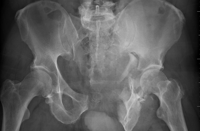 A 25-year-old man is brought to the emergency department following a high-speed motorcycle collision.  The patient is alert and in distress due to pain.  Blood pressure is 84/52 mm Hg and pulse is 130/min.  The airway is patent, the trachea is midline, and breath sounds are present bilaterally.  Heart sounds are normal.  There is bruising across the left chest wall, the lower abdomen, and the left flank.  The abdomen is soft and mildly tender to palpation diffusely, without rebound tenderness.  The bony pelvis is unstable to gentle downward pressure.  The left lower leg is visibly deformed but distal lower extremity capillary refill is symmetric.  There is blood present at the urethral meatus.  Chest x-ray reveals multiple rib fractures without pneumothorax.  Focused Assessment with Sonography for Trauma reveals no pericardial effusion or intraperitoneal free fluid.  Portable anteroposterior pelvic x-ray is shown in the image below:   In addition to resuscitation with IV crystalloid and/or blood products, which of the following is the best next step in management of this patient? A) CT scan of the abdomen and pelvis B) Placement of a pelvic binder C) Plain radiographs of the left tibia and fibula D) Reduction of the lower leg deformity E) Retrograde cystourethrogram