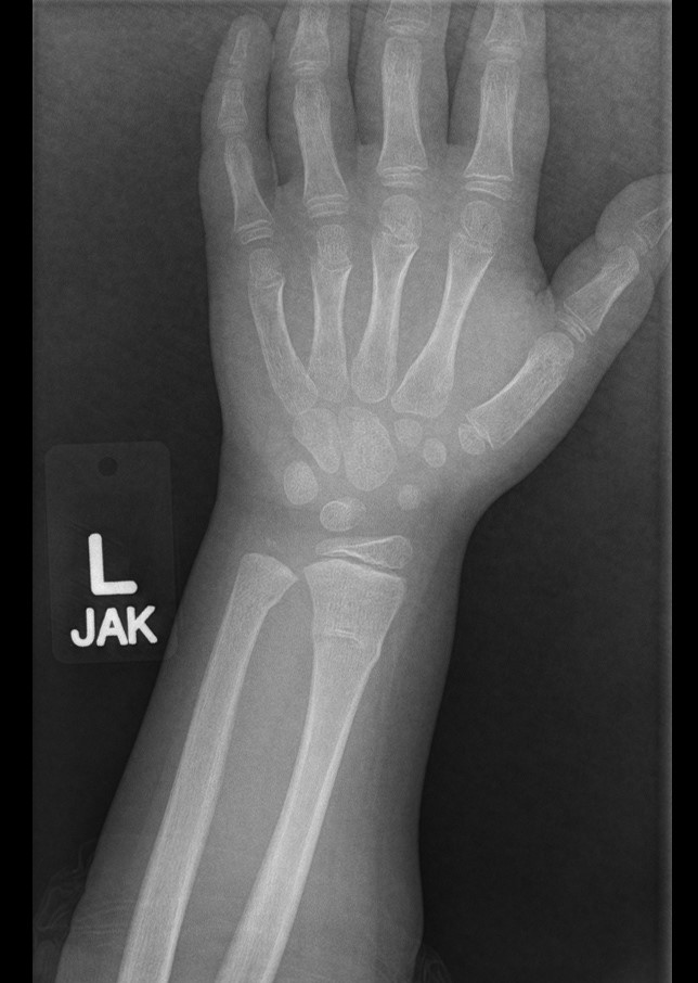 A 5-year-old boy is brought to the office due to left wrist pain lasting a day.  His mother states that he refuses to use the left hand because of the pain.  The patient has no previous medical conditions and is up to date with immunizations.  He consumes a balanced diet.  Vital signs and growth parameters are within normal limits for his age.  On physical examination, the patient holds the left arm against his body.  There is tenderness of the left wrist with no visible deformity.  When instructed, the patient moves all fingers except the left thumb.  Radiograph of the left forearm is shown in the image below:   Which of the following is the most likely cause of this patient's symptoms? A) Avascular bone necrosis B) Dietary vitamin D deficiency C) Hematogenous osteomyelitis D) Incomplete radial fracture E) Primary bone malignancy