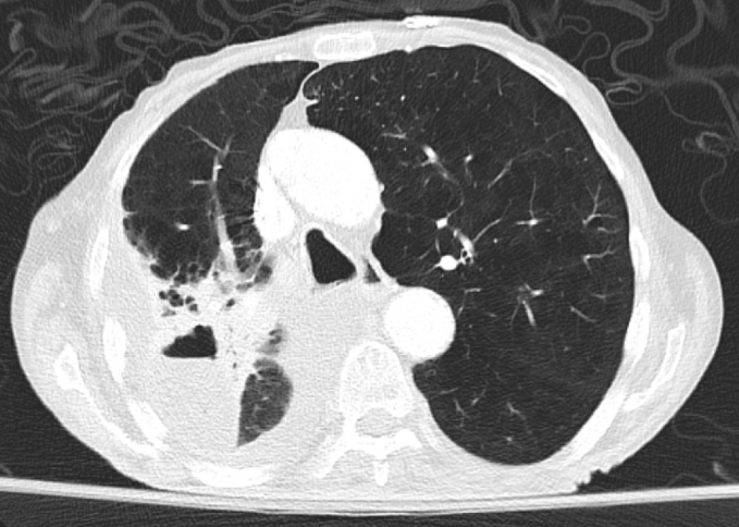 A 58-year-old man comes to the emergency department due to a week of fever, chills, and cough productive of foul-smelling sputum.  He has also had night sweats, anorexia, and fatigue.  The patient has no other medical conditions and takes no medications.  He has unstable housing and often sleeps in doorways or at shelters.  The patient smokes cigarettes and drinks alcohol but does not use injection drugs.  Temperature is 39.5 C (103.1 F) , blood pressure is 110/70 mm Hg, and pulse is 120/min.  The patient appears ill and disheveled with poor dentition.  Lung auscultation reveals right-sided crackles.  Leukocyte count is 18,000/mm<sup>3</sup>, and serum sodium is 128 mEq/L.  Chest imaging findings are shown in the image below:   Which of the following is the most likely cause of this patient's current condition? A) Anaerobic bacterial infection B) Aspergillus colonization C) Small cell lung cancer D) Gastric acid-induced lung injury E) Mycobacterium tuberculosis infection
