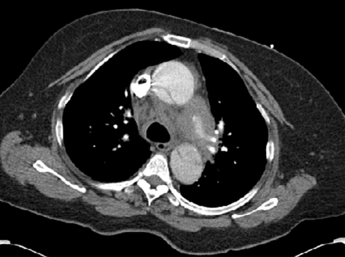 A 65-year-old man comes to the emergency department due to sudden-onset chest pain followed by syncope.  The pain started an hour ago, during which he had an episode of syncope lasting 1-2 minutes.  The patient has had no dyspnea or palpitations.  He has never had similar symptoms before.  Medical history is significant for hypertension and a 40-pack-year smoking history.  Blood pressure is 190/110 mm Hg in both arms; pulse is 100/min and regular; and respirations are 24/min.  Pulses are symmetric and equal in all extremities.  Jugular venous pressure is normal.  Breath sounds are normal on both sides.  There is an S4 gallop.  ECG shows changes consistent with left ventricular hypertrophy.  Serum troponin is normal.  D-dimer is elevated.  Chest x-ray shows an enlarged cardiac silhouette but is otherwise unremarkable.  CT scan of the chest is obtained and is shown below:   Which of the following is the best next step in management of this patient? A) Administration of thrombolytic therapy B) Admission to critical care unit for close blood pressure control C) Emergent surgical repair D) Unfractionated heparin infusion with close PTT monitoring E) Urgent coronary angiogram