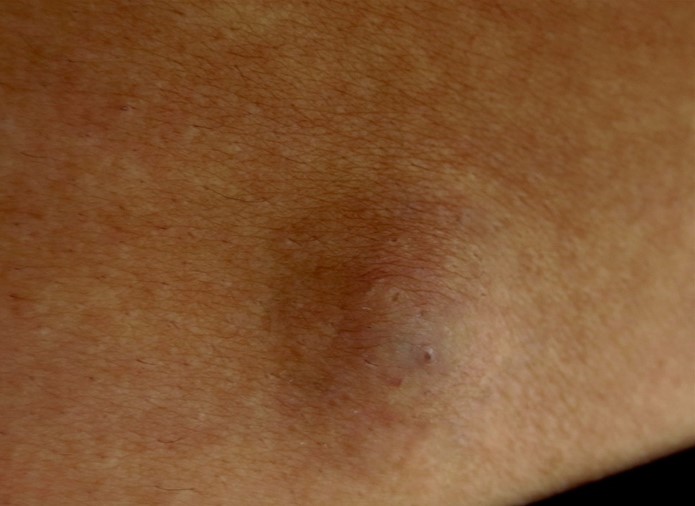 A 35-year-old man comes to the office due to a 2-month history of a skin bump on his lower back.  He noticed a similar bump in the same location 6 months ago, which spontaneously resolved after 3 weeks.  The patient recalls no trauma preceding either occurrence.  The bump has grown slightly larger in the past month, but there is no associated pruritus, pain, or other symptoms.  His medical history is unremarkable, and he has no history of tobacco or alcohol use.  Vital signs are within normal limits.  Skin examination shows a firm, mobile nodule, as shown in the image below.  There is no drainage from the lesion or tenderness to palpation.  The lesion does not change shape when pinched at the edges.  The remainder of the physical examination is within normal limits.   Which of the following is the most likely diagnosis? A) Basal cell carcinoma B) Dermatofibroma C) Epidermal inclusion cyst D) Lipoma E) Squamous cell carcinoma