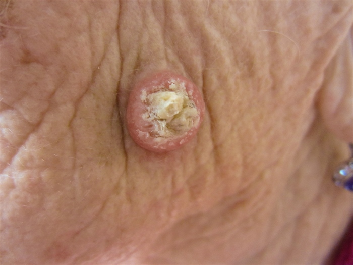 A 77-year-old woman comes to the office due to a skin lesion.  The patient first noticed it a few weeks ago when it grew rapidly and became painful.  However, since she scheduled her appointment 3 weeks ago, the lesion has become somewhat smaller and less painful.  Skin examination findings are as shown below:   Which of the following is the most likely diagnosis of this patient's skin lesion? A) Basal cell carcinoma B) Cutaneous horn C) Dermatofibroma D) Keratoacanthoma E) Molluscum contagiosum
