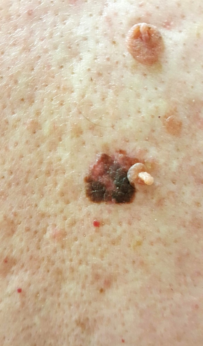 An 82-year-old man comes to the office for evaluation of a spot on his back.  He thinks the skin lesion has been present for many months to a few years but is unsure.  The lesion was asymptomatic until it recently started itching; it is large and dark, but the patient is not sure whether it is evolving.  The spot is shown in the image below:   Which of the following is the most appropriate next step in management of this patient's skin lesion? A) Cryotherapy destruction of the lesion B) Excisional biopsy of the lesion C) Observation over 3-6 months D) Punch biopsy from the lesion border E) Punch biopsy from the lesion center