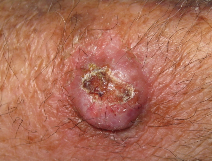 A 65-year-old man comes to the office due to a nonhealing ulcer on the left upper extremity.  For the last 2 months, he has had an enlarging ulcerated lesion, with intermittent bleeding and itching.  In the last 3 weeks, the patient has also noted local numbness, paresthesias, and burning pain.  He does not recall any injury prior to the onset of symptoms.  He has good appetite and reports no weight loss.  There is no fever, dyspnea, or cough.  The patient has a history of renal transplantation and takes an appropriate immunosuppressive regimen.  He does not use tobacco, alcohol, or illicit drugs.  Vital signs are normal.  Physical examination of the lesion is shown in the image below.  The remainder of the examination is unremarkable.   Which of the following is the most likely diagnosis? A) Basal cell carcinoma B) Disseminated cryptococcosis C) Kaposi sarcoma D) Malignant melanoma E) Squamous cell carcinoma