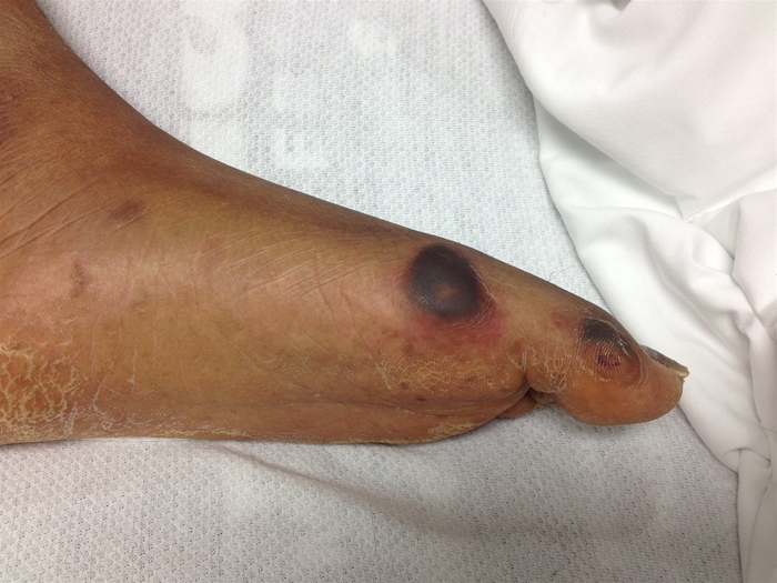 A 64-year-old woman is evaluated in a nursing home for a foot ulcer.  Three months ago, she had a cerebrovascular accident and now has residual hemiparesis with contractures.  Her other medical problems include hypertension, diabetes mellitus, hypercholesterolemia, coronary artery disease, and mild dementia.  Temperature is 37.2 C (98.9 F) , blood pressure is 142/63 mm Hg, and pulse is 62/min.  She is alert and oriented to person but not to time or place.  There are no new focal neurologic deficits.  Skin examination shows ulcerations on the left foot with mild erythema as shown in the image below.   Which of the following is the primary cause of this patient's skin ulcers? A) Arterial insufficiency B) Bacterial infection C) Poor glucose control D) Pressure necrosis E) Venous insufficiency