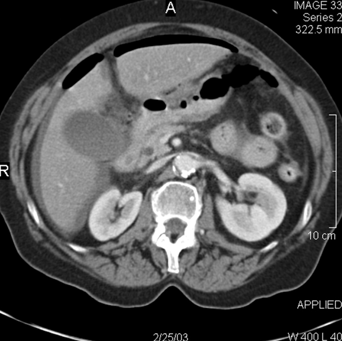 A 28-year-old man is brought to the emergency department after a high-speed motor vehicle collision in which he was the restrained driver.  The patient is awake and has left chest pain and vague abdominal discomfort.  Blood pressure is 114/74 mm Hg and pulse is 112/min.  Physical examination shows chest and abdominal ecchymoses and tenderness in the distribution of the seat belt.  Breath sounds are equal bilaterally.  Heart sounds are normal.  The abdomen is mildly tender.  Chest x-ray reveals a left sixth rib fracture without pneumothorax.  Focused assessment with sonography is negative for free abdominal fluid.  CT scan of the abdomen shows thickened proximal small bowel and a small mesenteric hematoma.  The patient is hospitalized for monitoring and supportive care.  Over the next 24 hours, he develops worsening abdominal pain, nausea, vomiting, and abdominal tenderness with guarding.  Repeat CT scan of the abdomen is shown in the image below:   Which of the following is the best next step in management of this patient? A) Diagnostic peritoneal lavage B) Increased analgesia and close observation C) Mesenteric angiography D) Surgical exploration E) Upper gastrointestinal series