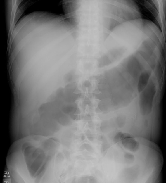A 74-year-old man is brought to the emergency department due to worsening lethargy and abdominal pain and distension.  For the past several days, the patient has had watery diarrhea.  However, in the last 24 hours, he has not had a bowel movement, and the abdominal pain and distension have worsened, with the patient becoming progressively more lethargic.  Medical history is significant for hypertension, myocardial infarction, atrial fibrillation, and stroke with hemiplegia.  He was recently hospitalized for treatment of an infected pressure ulcer.  Temperature is 38.8 C (101.8 F) , blood pressure is 106/60 mm Hg, and pulse is 118/min.  On physical examination, the patient is ill appearing and somnolent.  Mucous membranes are dry.  The abdomen is distended and diffusely tender.  Bowel sounds are decreased.  Leukocyte count is 18,000/mm<sup>3</sup>.  Serum potassium is 3.2 mEq/L.  Abdominal x-ray is shown in the image below:   Which of the following is the most likely cause of this patient's current condition? A) Bacterial invasion and perforation of the bowel wall B) Electrolyte dysfunction causing ileus C) Entanglement of a bowel loop around fibrous bands D) Microbial toxin-induced colonic inflammation E) Sudden decrease in colonic perfusion pressure