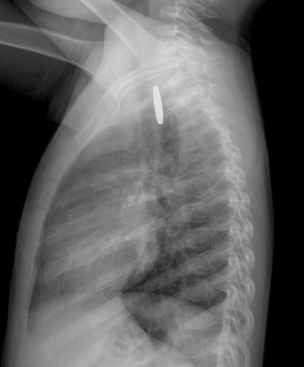 A 3-year-old boy is brought to the emergency department after swallowing a battery.  About an hour ago, his father was changing his watch battery when the patient grabbed and swallowed it and then coughed for several minutes.  Since then, he has been able to drink and talk normally.  Vital signs are normal.  The patient appears alert and comfortable.  He is not drooling, and the posterior oropharynx is clear.  The lungs are clear to auscultation bilaterally.  Cardiac examination is unremarkable.  The abdomen is soft and nontender.  Chest x-ray on anteroposterior view shows a radiopaque, circular object with a halo sign.  The lateral view is shown below:   Which of the following is the best next step in management of this patient? A) Barium contrast study B) Blind sweep for object C) Bronchoscopy D) Observation and repeat x-ray in 24 hours E) Upper gastrointestinal endoscopy