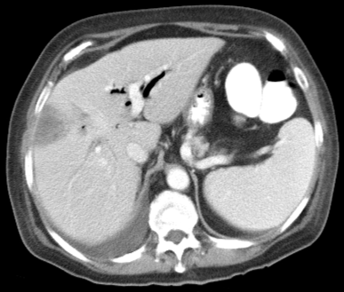 A 70-year-old man comes to the hospital due to worsening right upper quadrant pain, fever, and anorexia for the past 2 days.  Today, he also developed chills.  The patient was treated for acute diverticulitis 4 weeks ago.  Medical conditions also include type 2 diabetes mellitus and hypertension.  He does not use tobacco, alcohol, or illicit drugs.  The patient has not traveled recently.  Temperature is 39.3 C (102.7 F) , blood pressure is 130/80 mm Hg, pulse is 98/min, and respirations are 18/min.  Examination shows no jaundice.  The right upper quadrant is markedly tender with some guarding on palpation.  Bowel sounds are normal, and there is no ascites.  Laboratory results are as follows:   CT scan of the abdomen is shown in the exhibit:   Blood cultures are obtained.  Which of the following is the best next step in diagnosis? A) Percutaneous aspiration B) Peripheral smears for Plasmodium species C) Serology for Echinococcus granulosus D) Serology for Entamoeba histolytica E) Stool test for Clostridioides (formerly Clostridium)  difficile toxin F) Stool test for ova and parasites