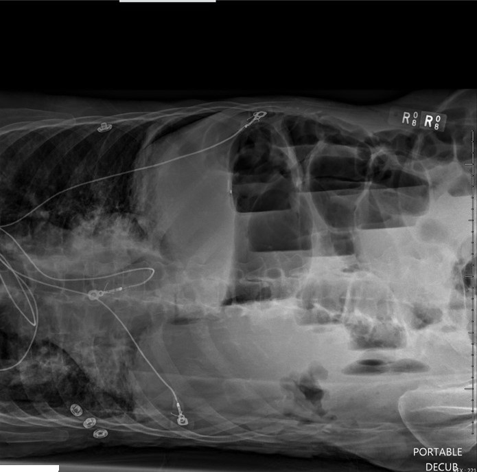 A 78-year-old man is brought to the emergency department after he was found obtunded and moaning in bed at his nursing care facility.  For 2 days prior, he refused to eat most of his food.  Medical history is significant for early Alzheimer disease, hypertension, hyperlipidemia, bilateral knee replacement, and right hemicolectomy for stage I colon cancer.  The patient has a 50-pack-year smoking history but no longer smokes or drinks alcohol.  Temperature is 38.7 C (101.7 F) , blood pressure is 102/54 mm Hg, pulse is 114/min, and respirations are 22/min.  The patient is holding his abdomen and groaning.  He opens his eyes to a loud voice but does not follow commands.  The abdomen is distended, tympanitic to percussion, and rigid to palpation.  Stool guaiac test is negative.  The patient cannot tolerate sitting upright.  Lateral decubitus x-ray of the abdomen is shown below.   Which of the following is the best next step in management of this patient? A) Barium enema B) Contrast angiography C) CT scan of the abdomen with IV contrast D) Nasogastric tube and serial abdominal examinations E) Surgical exploration F) Upper gastrointestinal series