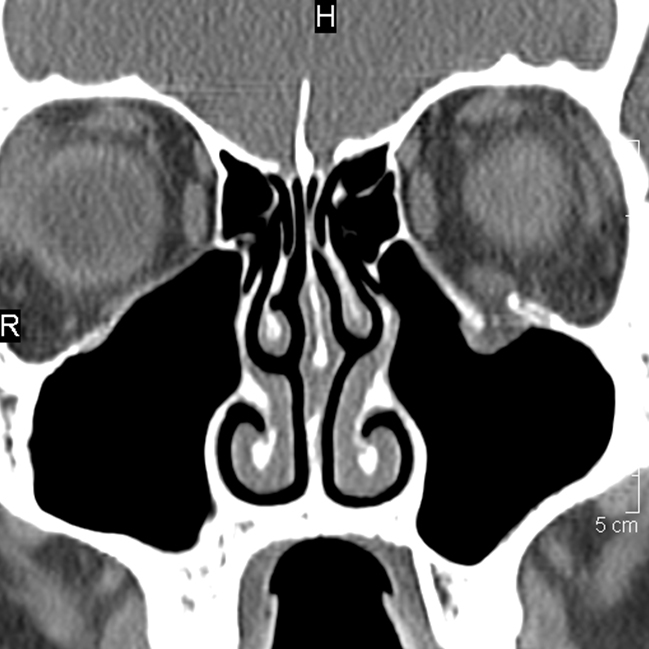 A 24-year-old man comes to the emergency department for evaluation of eye pain and swelling.  He was involved in an altercation last night after significant alcohol use but does not remember any further details.  The patient has double vision when he attempts to look up.  On examination, the left side of the face is significantly swollen, tender, and ecchymotic.  Visual acuity is normal.  He is unable to look up with his left eye.  CT scan is shown below:   Which of the following is the most likely reason for this patient's diplopia? A) Muscle entrapment B) Open globe injury C) Orbital cellulitis D) Orbital hematoma E) Trochlear nerve (CN IV)  injury