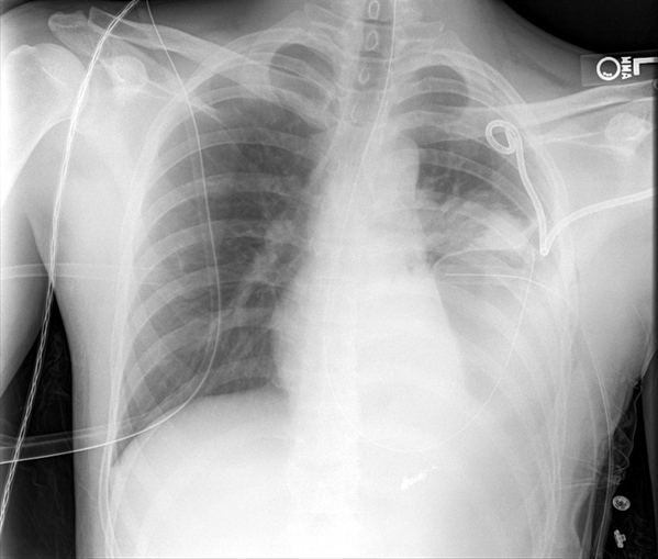 A 27-year-old man is brought to the emergency department after a high-speed motor vehicle collision.  On arrival, his blood pressure is 90/52 mm Hg, pulse is 122/min, and respirations are 30/min.  The patient is in moderate respiratory distress.  There are bruises on the anterior chest wall and abdomen.  No breath sounds are heard in the left lung, and initial chest x-ray shows hemopneumothorax.  Fluid resuscitation is given, left-sided chest tubes and a nasogastric tube are placed, and the patient is admitted to the trauma floor after stabilization.  Four days later, the chest tubes continue to drain appropriate serosanguinous fluid, but the patient still feels short of breath.  He has an occasional dry, nonproductive cough.  Current temperature is 36.8 C (98.2 F) , blood pressure is 118/78 mm Hg, pulse is 88/min, and respirations are 20/min.  A repeat chest x-ray shows the following.   Which of the following is the most likely cause of the patient's continued respiratory distress? A) Aortic rupture B) Diaphragmatic injury C) Flail chest D) Left lower lobe pneumonia E) Pulmonary embolism F) Recurrent pneumothorax