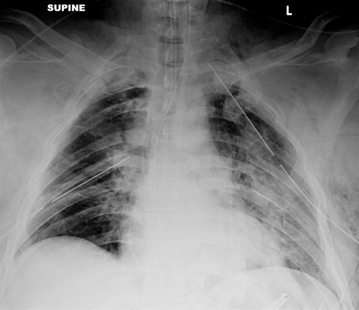 A 22-year-old man is brought to the emergency department after a high-speed motor vehicle collision.  Blood pressure is 102/60 mm Hg, pulse is 122/min, and respirations are 40/min.  Pulse oximetry is 88% on 6 L oxygen.  The patient is alert but appears to be in respiratory distress.  Breath sounds are diminished bilaterally, and bilateral chest tubes are placed.  The patient's respiratory status initially improves; however, over the next hour, he develops respiratory failure, requiring intubation and mechanical ventilation.  Postintubation chest x-ray is shown below.   Which of the following is the most likely cause of this patient's need for mechanical ventilation? A) Acute respiratory distress syndrome B) Blunt cardiac injury C) Diaphragmatic rupture D) Fat embolism E) Flail chest F) Tension pneumothorax