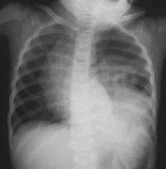 A 4-year-old boy is brought to the emergency department with vague chest discomfort.  Two months ago, the patient was involved in a high-speed motor vehicle collision but sustained only minor injuries.  He was observed in the emergency department overnight and discharged home.  Medical history is otherwise unremarkable.  Vital signs are normal.  Auscultation of the lungs shows decreased air entry into the left lower base.  An x-ray of the chest is shown below.   Which of the following is the best next step in management of this patient? A) Chest tube placement B) CT scan of the chest and abdomen C) Flexible bronchoscopy D) Intravenous antibiotics E) Reassurance and outpatient follow-up