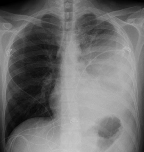 A 45-year-old man with HIV comes to the emergency department due to increasing shortness of breath, left-sided chest pain, chills, and productive cough.  The symptoms began 7 days ago.  At first, the patient thought he had the flu, but after 3 days he began coughing up green phlegm and developed left-sided chest pain.  The pain is worse with deep breaths or cough.  CD4 count is unknown.  He smokes cigarettes and drinks alcohol regularly.  Temperature is 38.9 C (102 F) , blood pressure is 110/70 mm Hg, pulse is 110/min, and respirations are 26/min.  Physical examination shows poor dentition and decreased breath sounds over the left lung base.  Chest x-ray is shown below.   Which of the following is the most likely cause of this patient's current symptoms? A) Acute pericarditis B) Bronchopleural fistula C) Empyema D) Lung abscess E) Pneumocystis jiroveci pneumonia F) Pneumothorax G) Viral myocarditis