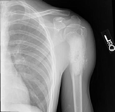 A 15-year-old boy comes to the physician with left shoulder joint pain and swelling.  He has had these symptoms for the past 3 months and they are getting progressively worse.  He has no fever, weight loss, or night sweats.  The patient lifts weights and plays baseball 5 days a week.  He has taken acetaminophen and ibuprofen with little relief.  Examination shows a tender mass at the left proximal humerus.  Range of motion is normal.  Laboratory evaluation shows elevated alkaline phosphatase, erythrocyte sedimentation rate, and lactate dehydrogenase.  X-ray of the shoulder is shown in the photograph below.   Which of the following is the most likely diagnosis? A) Ewing sarcoma B) Osteoid osteoma C) Osteomyelitis D) Osteosarcoma E) Stress fracture