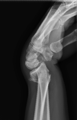 A 58-year-old previously healthy woman comes to the emergency department due to wrist pain after a fall.  The patient was walking her dog when it suddenly ran toward a squirrel, pulling her to the ground.  She tried to brace herself with her outstretched hand and injured the wrist.  Physical examination shows a gross deformity of the wrist with extensive swelling and bruising.  Distal pulses and testing for capillary refill are normal.  The patient had no sensory symptoms initially but developed paresthesia in the affected hand while in the emergency department.  X-ray results are shown below:   Which of the following is most likely to be abnormal due to associated nerve injury in this patient? A) Abduction of thumb against resistance B) Adduction of the index and 4th digit C) Extension of fingers against resistance D) Sensation on dorsum of thumb-index web space E) Two-point discrimination over little finger