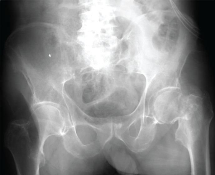 A 73-year-old man is brought to the emergency department after his daughter found him on the floor.  The patient says that he fell and now his left hip  hurts a lot,  but he does not recall any details of the fall.  Over the past several days, he has felt short of breath with a cough and intermittent palpitations that he attributed to  coming down with the flu.   His other medical problems include hypertension, type 2 diabetes mellitus, chronic obstructive pulmonary disease, and benign prostatic hyperplasia.  His temperature is 37.3 C (99.2 F) , blood pressure is 118/76 mm Hg, pulse is 116/min, and respirations are 24/min.  Pulse oximetry shows 95% on 2 L/min of oxygen by nasal cannula.  Breath sounds are decreased at the right lung base, and crackles are present at the left lung base.  The left lower extremity is shortened and externally rotated.  Initial laboratory studies, including complete blood count, glucose, and serum chemistries, are normal.  The pain improves with a dose of hydromorphone.  X-ray findings are shown below.   Which of the following is the best next step in management of this patient? A) Electrocardiogram, cardiac markers, and chest x-ray B) Hemiarthroplasty for femoral neck fracture C) Intravenous crystalloids D) Lower-extremity skeletal traction E) Skilled nursing care, with hip surgery after the viral syndrome resolves