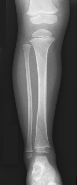 A 15-month-old boy is brought to the emergency department due to refusal to stand.  Earlier today, the patient fell from a standing height after tripping on toys.  The event was witnessed by several employees at the day care that he has been attending for a week.  He cried initially but was consoled and continued playing.  At home, however, he was unwilling to walk or bear weight on his right leg.  The patient has met appropriate growth parameters and developmental milestones.  Weight and height are at the 75th percentile.  Temperature is 37.7 C (99.9 F) .  The patient is sitting comfortably in his mother's lap.  The abdomen is soft with no organomegaly.  The right distal tibia is slightly edematous compared with the left.  Palpation over the right distal tibia elicits crying.  Skin examination shows scattered bruises on the bilateral knees and lower legs.  The radiograph is shown in the image below:   In addition to leg immobilization, which of the following is the best next step in evaluation of this patient? A) Bone marrow evaluation B) Calcium, phosphorus, and parathyroid hormone levels C) Collagen type 1 mutation testing D) MRI of the tibia E) No additional workup