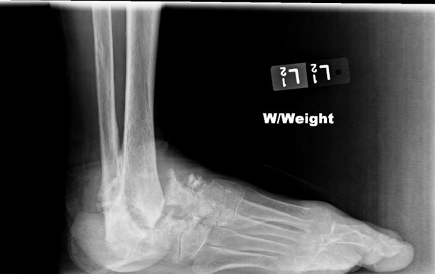 A 62-year-old man comes to the office due to difficulty walking and mild pain in the left foot for the past several months.  He now ambulates with a cane and recently began using an old ankle brace for support.  The patient's medical history is significant for type 1 diabetes mellitus, hypertension, and hypercholesterolemia.  Physical examination shows a significantly deformed left ankle and a mildly deformed left foot.  X-ray of the left foot with weight bearing shows bone loss, large osteophytes, and several extraarticular bone fragments, as seen in the image below.   Which of the following is the most likely cause of this patient's foot pain? A) Avascular necrosis B) Bacterial infection C) Bone demineralization D) Hyperuricemia E) Nerve damage F) Rheumatoid arthritis