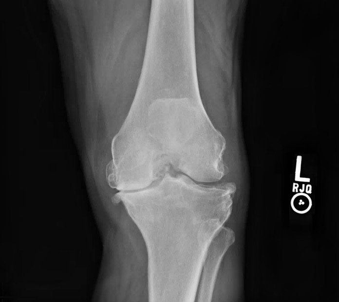A 67-year-old woman comes to the office due to knee pain.  For the past year, she has had gradually increasing pain in the left knee that is worse with prolonged walking or climbing stairs.  The patient has also had brief (5-10 min)  stiffness in the knee when she first rises from bed in the morning.  She reports minimal pain at rest and no nocturnal pain.  There are no clicking or locking symptoms.  Her pain is relieved with topical diclofenac but recurs if the patient does not use it regularly.  Vital signs are normal.  Examination shows slightly reduced flexion at the left knee compared to the right.  No joint tenderness, warmth, or palpable effusion is present.  There is no laxity with varus or valgus stress or with anterior or posterior traction on the proximal tibia.  X-ray of the knee is shown in the image below:   Which of the following is the most appropriate next step in management of this patient's knee pain? A) Arthroscopic lavage and debridement B) Hyaluronic acid injection C) MRI of the knee D) Quadriceps strengthening exercises E) Rheumatoid factor assay