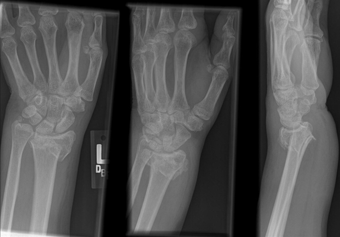 A 45-year-old man comes to the emergency department due to left wrist pain after a fall.  The patient was walking in his house when he tripped over a rug and landed on his outstretched hand.  His wrist swelled and he applied ice, which did not improve the swelling or pain.  Medical history is notable for celiac disease, hypertension, and hypothyroidism for which he is on thyroid hormone supplementation.  The patient does not use tobacco, alcohol, or illicit drugs.  He has no known medication allergies.  BMI is 20 kg/m<sup>2</sup>.  Examination shows a  dinner-fork  deformity at the left wrist.  The wrist is swollen and tender to palpation.  Sensation over the left hand is intact, and the patient is able to move all his fingers.  X-ray of the left wrist is shown below.   Which of the following is the most significant risk factor for bone fracture in this patient? A) Age B) BMI C) Celiac disease D) Hypertension E) Hypothyroidism F) Gender