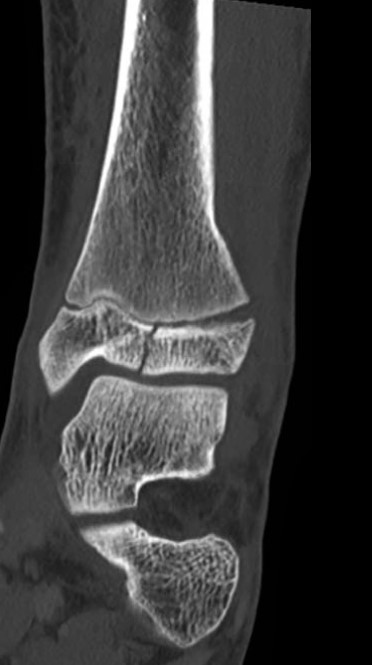 A 12-year-old boy is brought to the emergency department by his parents to evaluate pain and swelling in his right ankle.  The boy was riding his skateboard when he attempted a jump and landed awkwardly on his foot.  He has not been able to put weight on his leg since the injury.  On examination, there is diffuse swelling of the right ankle with no visible deformity.  Examination is limited as any attempted motion of the ankle causes severe pain.  Bilateral distal pulses are normal.  Sensation is intact.  Radiographs of the ankle partially visualize a fracture of the distal tibia.  A CT scan of the fracture is shown below:   This patient's fracture places him at increased risk for which of the following complications? A) Acute limb ischemia B) Avascular necrosis C) Compartment syndrome D) Limb-length discrepancy E) Persistent foot drop
