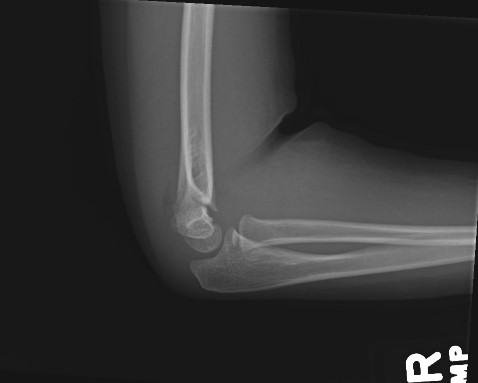 A 7-year-old girl is brought to the emergency department due to a right arm injury.  While jumping on a trampoline, she slipped and fell onto her outstretched right hand.  The patient had immediate pain and would not move her arm.  She did not hit her head or lose consciousness.  On examination, the patient is crying in pain, with significant ecchymosis and swelling just above the elbow.  She is holding the right arm in flexion and winces when it is moved.  X-ray reveals a supracondylar fracture with posterior displacement of the distal humerus fragment, as shown in the image below.   Which of the following is at greatest risk of injury in this patient? A) Axillary artery B) Axillary nerve C) Brachial artery D) Brachial plexus E) Ulnar nerve