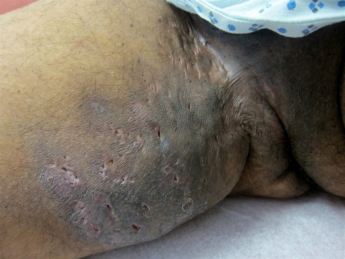 A 24-year-old woman comes to the office due to painful bumps in her groin.  She has had these before, and they typically resolve within a few weeks, sometimes after draining spontaneously.  Now the bumps occur more frequently and last longer, and sitting has become painful.  The patient has no chronic medical conditions or prior surgeries.  Temperature is 36.7 C (98 F) .  BMI is 35 kg/m<sup>2</sup>.  Physical examination is shown below:   Which of the following is the most likely diagnosis in this patient? A) Genital herpes B) Granuloma inguinale C) Hidradenitis suppurativa D) Lymphogranuloma venereum E) Vulvar lichen sclerosus