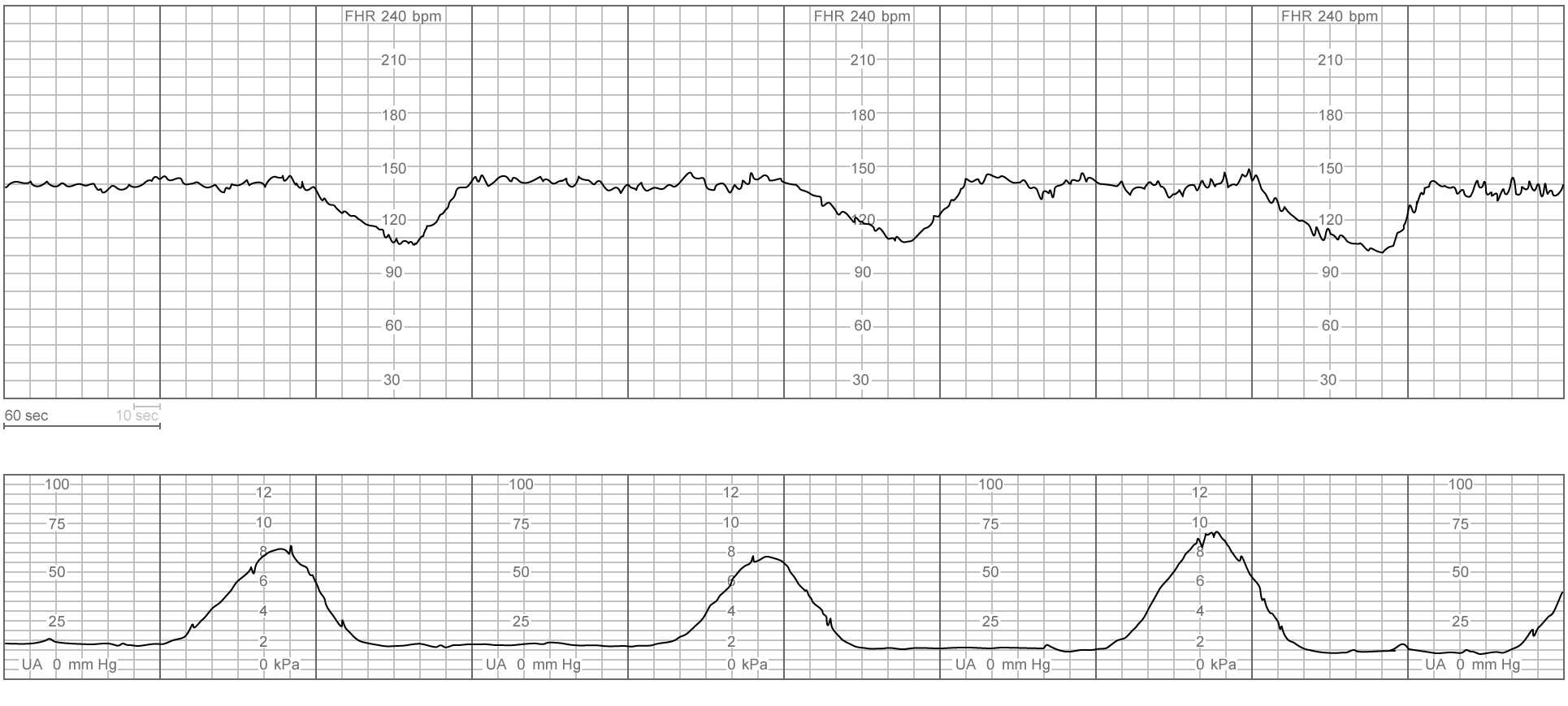 A 32-year-old primigravid woman at 37 weeks gestation and in active labor is admitted to the labor and delivery unit.  On admission, the cervix is 4 cm dilated and 80% effaced, with the fetal vertex at 0 station.  The membranes are grossly ruptured with thin, clear amniotic fluid.  Fetal heart rate tracing is category I, and the patient receives epidural anesthesia for pain management; she reports complete pain relief.  The fetal heart rate tracing 10 minutes later is shown in the following image:   Maternal blood pressure is 60/40 mm Hg and pulse is 60/min.  Repeat cervical examination shows the cervix to be 5 cm dilated and 100% effaced and the fetal vertex at +1 station.  In addition to intravenous fluids, which of the following is the best next step in management of this patient? A) Amnioinfusion B) Naloxone C) Phenylephrine D) Terbutaline