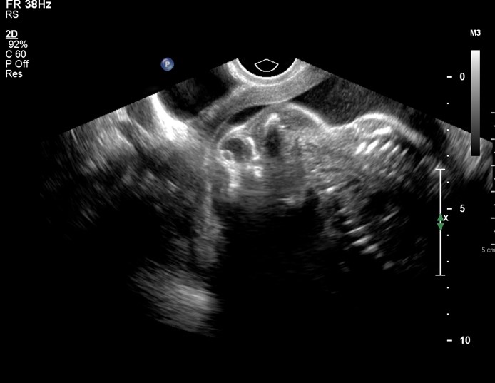 A 21-year-old woman, gravida 1 para 0, at 20 weeks gestation comes to the office for a fetal anatomy ultrasound.  Her initial prenatal visit was last week, and she has had no vaginal bleeding, contractions, or leakage of fluid.  The patient had not realized she was pregnant because her menses are irregular, typically occurring only once every 2 or 3 months.  She has no known medical conditions and takes no medications.  Blood pressure is 146/98 mm Hg and pulse is 88/min.  BMI is 30 kg/m<sup>2</sup>.  Ultrasound shows a large defect in the calvaria and meninges, with only a small cerebellum and brainstem, as seen in the image below.   The remainder of the fetal anatomy appears normal.  Amniotic fluid volume measures 26 cm (normal: <24 cm) .  Which of the following maternal factors is most commonly associated with this fetal anomaly? A) Inadequate folate intake B) Incomplete vaccination status C) Poorly controlled hypertension D) Undercooked meat consumption E) Untreated sexually transmitted infection