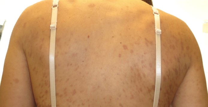 A 24-year-old woman, gravida 1 para 0, at 31 weeks gestation comes to urgent care due to a rash on her back.  Her mother first noticed a small rash on the patient's back a week ago, and it has spread despite the use of a topical cream.  The patient has had no prenatal care.  Vital signs are normal.  Fetal heart rate is 150 /min.  Fundal height is 28 cm.  The rash extends across her trunk and extremities, including the palms of the hands and the soles of the feet.  The lesions do not bleed, and there are no excoriations.  The rash is seen in the image below:   Which of the following is the most likely diagnosis in this patient? A) Intrahepatic cholestasis of pregnancy B) Pityriasis rosea C) Polymorphic eruption of pregnancy D) Secondary syphilis E) Tinea versicolor