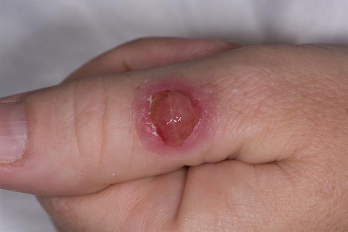 A 29-year-old woman, gravida 1 para 0, at 20 weeks gestation comes to the office for evaluation of a lesion on her hand.  The patient first noticed the lesion a month ago after working in her garden and scratching her thumb.  She initially used a topical antibiotic ointment, but the lesion continued to grow and occasionally bled.  There has been no purulent drainage, and the patient has had no associated fever or chills.  Her pregnancy has been uncomplicated, and she has no chronic medical conditions.  Temperature is 36.7 C (98.1 F) , blood pressure is 120/80 mm Hg, and pulse is 65/min.  Fetal heart tones are 150/min.  Examination of the hand is shown in the image below:   Which of the following is the most likely diagnosis in this patient? A) Bacillary angiomatosis B) Basal cell carcinoma C) Kaposi sarcoma D) Keratoacanthoma E) Pyogenic granuloma