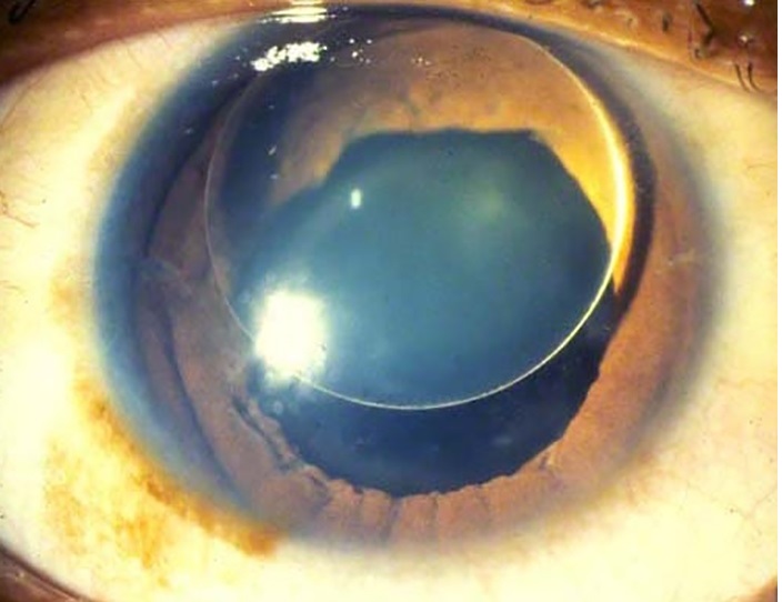 An 8-year-old girl is brought to the emergency department by her mother for evaluation of blurry vision.  The patient reports that she woke up this morning with a sudden onset of blurry vision.  Her mother states,  She has worn thick glasses since age 2, but this morning she said that everything was blurry in her left eye, even with her glasses on.   There is no associated erythema or discharge.  The patient does not recall any trauma.  The girl has no chronic medical conditions and has had no surgeries.  She is an honor roll student in the 3rd grade.  The patient lives with her mother, and her father left when she was an infant.  The mother's medical history is unremarkable but she says,  I think her father had a similar problem when he was younger and had a weak heart.   The patient is at the 50th and >95th percentiles for weight and height, respectively.  She is alert and in no distress.  The right pupil is 4 mm and briskly reactive; the left pupil is 1 mm.  Bilateral globes appear intact with no conjunctival injection.  Extraocular eye movements are intact bilaterally and visual fields are full to confrontation bilaterally.  A dilated direct ophthalmoscopic examination followed by a slit-lamp examination of the left eye reveals the following:   Which of the following conditions is this patient at greatest risk of developing? A) Aortic dissection B) Berry aneurysm C) Glucose intolerance D) Retinoblastoma E) Venous thromboembolism