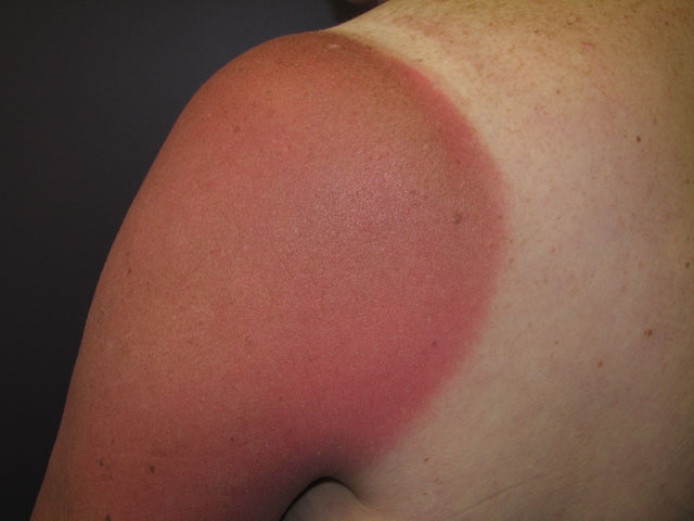 A 17-year-old girl is brought to an urgent care center for sunburn.  She was jogging outside for an hour today and subsequently developed redness and pain on the exposed portion of her arms and face.  The patient says,  It wasn't even that sunny today.  I've been outside for a lot longer than this and have never had a sunburn this bad.   Her medical history includes acne vulgaris for which she was prescribed a topical and an oral medication, neither of which she can remember by name.  She does not take any other medications and has no allergies.  The patient is a long-distance runner for her high school track team.  She lives with her father, who has dyslipidemia.  Physical examination shows numerous comedones, papules, and pustules on her face and chest.  Confluent areas of erythema, warmth, and edema are present on the patient's face and upper extremities.  Her left arm is shown in the image below.   Which of the following treatments is indicated for this patient's condition? A) Benzocaine anesthetic spray B) Oral prednisone C) Supportive care D) Topical benzoyl peroxide E) Topical silver sulfadiazine