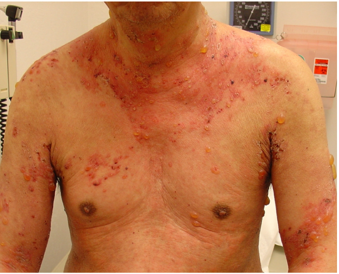 A 70-year-old man comes to the office due to a skin rash.  He has widespread redness and blistering across his neck and trunk, which are associated with severe itching.  The rash was preceded by 4 weeks of widespread pruritus and occasional urticaria.  The patient has a history of hypertension controlled with amlodipine for 2 years and lisinopril for the last 6 months.  Vital signs are within normal limits.  On examination, he has scattered vesicles and bullae with underlying erythema and urticaria, as shown in the image below:   Which of the following is the most appropriate next step in management of this patient's condition? A) Discontinuation of lisinopril and follow-up in 5-7 days B) Oral prednisone and follow-up in 3-4 days C) Oral valacyclovir for 10 days D) Skin biopsy E) Topical triamcinolone