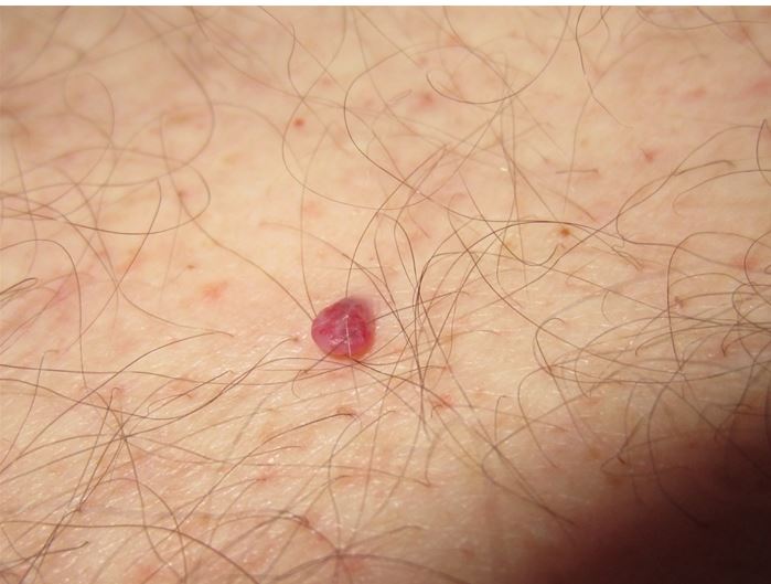 A 48-year-old man comes to the physician with a red skin lesion on his abdomen.  He first noticed it 6 months ago and says that it has been enlarging recently.  The lesion bleeds occasionally when disturbed but is otherwise asymptomatic.  The patient has a history of hypertension and actinic keratosis.  He has a 25-pack-year smoking history and drinks a 6-pack of beer daily.  Physical examination findings are shown in the image below.   Which of the following is the most appropriate next step in management of this patient's skin lesion? A) Electrocauterization with shave excision B) HIV testing C) Liver function tests D) Propranolol E) Reassurance only