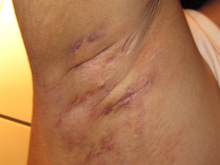 A 29-year-old man comes to the physician with nodules under his arm.  He reports a 6-month history of slowly enlarging nodules in his right axilla associated with mild discomfort.  He has a history of chronic obesity but is otherwise healthy.  The patient has a 10-pack-year smoking history and does not drink alcohol.  Skin examination shows swollen, nodular lesions in his right axilla with moderate scarring and mild tenderness to palpation.  He has no other significant skin lesions.   Which of the following is the best next step in management of this patient? A) Incision and drainage B) Oral doxycycline C) Surgical excision D) Topical nystatin powder E) Warm compresses