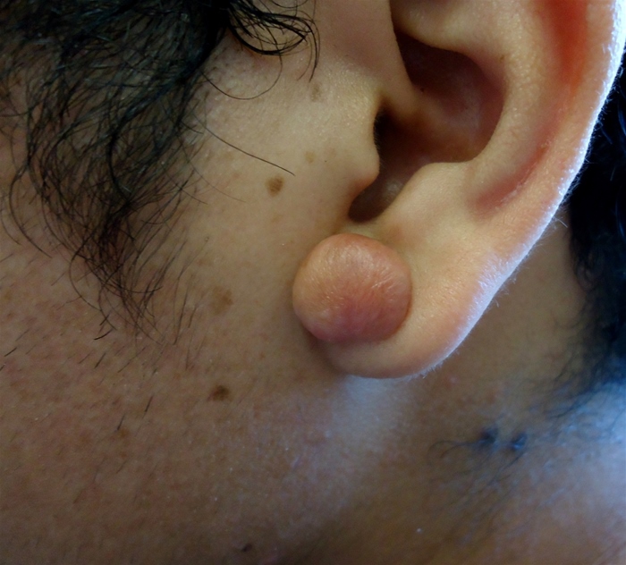 A 28-year-old man comes to the physician due to pain in his left earlobe.  He pierced his earlobe to be able to wear earrings 3 months ago.  The puncture wound never healed well, and he has experienced itching and sharp pains there ever since.  His medical history is otherwise unremarkable.  He is currently not taking any medications.  On physical examination, there is excessive scar tissue formation on the earlobe at the site of the piercing as shown.   Prior to treatment, what potential complications should be reviewed with the patient? A) Fungal meningitis B) Hypopigmentation C) Local dermatitis D) Malignant conversion E) Recurrent keloid formation