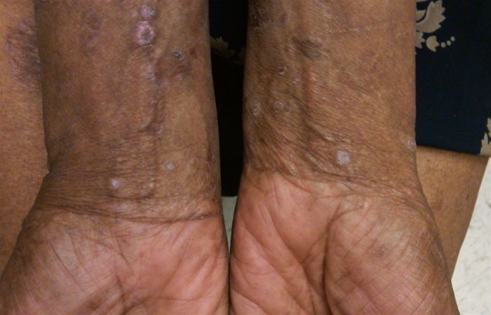A 46-year-old man comes to the physician's office for a pruritic rash.  The patient was in his usual state of health until 2 months ago, when dark red lesions appeared over his wrists.  The lesions progressed, and a few weeks later he developed similar lesions on his lower legs.  This morning, the patient saw some  white lines  in his mouth and called for an urgent appointment.  He has no fevers, chills, weight loss, or diarrhea.  The patient has a history of hypertension, which is controlled with lisinopril.  He does not use tobacco or alcohol, but has a remote history of intravenous drug use.  Physical examination shows multiple, discrete violaceous papules and plaques over the flexural surfaces of the patient's wrists and lower legs as shown in the image below.  Examination of the buccal mucosa shows whitish lacy streaks with a slight background erythema.  The rest of his physical examination is unremarkable.    Which of the following is the best next step in diagnosing this patient's condition? A) Microscopic examination of skin scrapings in potassium hydroxide (KOH)  B) Microscopic examination of skin scrapings in saline solution C) Perform a chest radiograph D) Perform a skin biopsy E) Refer the patient to an infectious disease specialist