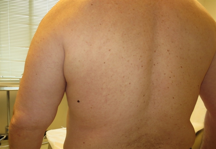 A 29-year-old man comes to the physician for a routine preventive examination.  He is currently feeling well but states that he has always had  some dark spots  on his back.  The patient has no family history of heart disease or cancer.  He does not spend much time outdoors and had no prior sunburn.  He does not smoke.  Physical examination shows many pigmented lesions on his back as shown below.   The following 8-mm lesion is seen on close skin inspection.   Which of the following is the best next step in the management of this patient's skin lesion? A) Assessment of glycemic control and insulin resistance B) Excisional biopsy C) Incisional biopsy D) Photographic documentation and comparison in 6-12 months E) Sentinel lymph node biopsy