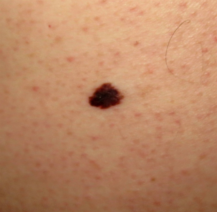 A 29-year-old man comes to the physician for a routine preventive examination.  He is currently feeling well but states that he has always had  some dark spots  on his back.  The patient has no family history of heart disease or cancer.  He does not spend much time outdoors and had no prior sunburn.  He does not smoke.  Physical examination shows many pigmented lesions on his back as shown below.   The following 8-mm lesion is seen on close skin inspection.   Which of the following is the best next step in the management of this patient's skin lesion? A) Assessment of glycemic control and insulin resistance B) Excisional biopsy C) Incisional biopsy D) Photographic documentation and comparison in 6-12 months E) Sentinel lymph node biopsy