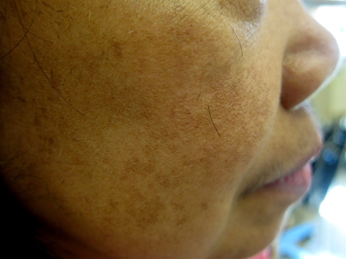 A 34-year-old woman, gravida 2 para 1, at 32 weeks gestation comes to the office for routine prenatal care.  The patient reports no contractions, vaginal bleeding, or leakage of fluid.  Fetal movement is normal.  The patient reports a dark rash on her face that she first noticed 2 weeks ago.  She has applied an over-the-counter moisturizer to the rash daily for the last week but has not noticed any improvement.  The patient has no chronic medical conditions and no previous surgeries.  She takes a daily prenatal vitamin and does not use tobacco, alcohol, or illicit drugs.  The patient has no known drug allergies.  She works as an accountant and enjoys gardening on the weekends.  Blood pressure is 120/80 mm Hg and pulse is 65/min.  The fetal heart rate is 140/min by Doppler ultrasound.  Fundal height is 32 cm.  Skin examination is shown in the image below.  The remainder of the physical examination is unremarkable.   Which of the following is the best next step in management of this patient? A) Advise the use of a broad-spectrum sunscreen B) Order a morning serum cortisol concentration C) Order serum iron studies D) Prescribe a topical retinoid cream E) Prescribe topical metronidazole
