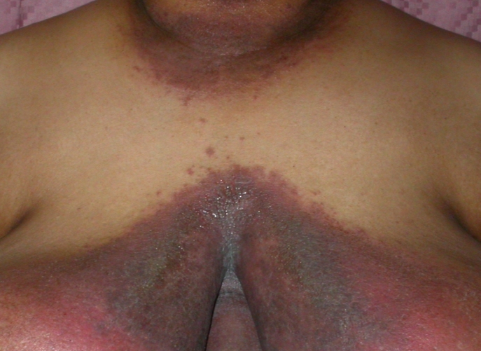 A 45-year-old woman comes to the office for evaluation of a rash.  The rash started 3 weeks ago under her breasts and has gradually spread to her chest.  There is no associated pruritus.  The patient has a history of diabetes, hypertension, and gastroesophageal reflux disease.  Her medications include hydrochlorothiazide, metformin, and omeprazole.  She has no history of tobacco or alcohol use.  The patient's vital signs are within normal limits.  Her BMI is 38 kg/m<sup>2</sup>.  Skin examination is shown in the image below.  There is no warmth or tenderness around the lesions.   Which of the following is the most likely organism causing this patient's rash? A) Candida albicans B) Corynebacterium minutissimum C) Staphylococcus aureus D) Trichophyton rubrum E) Varicella zoster virus